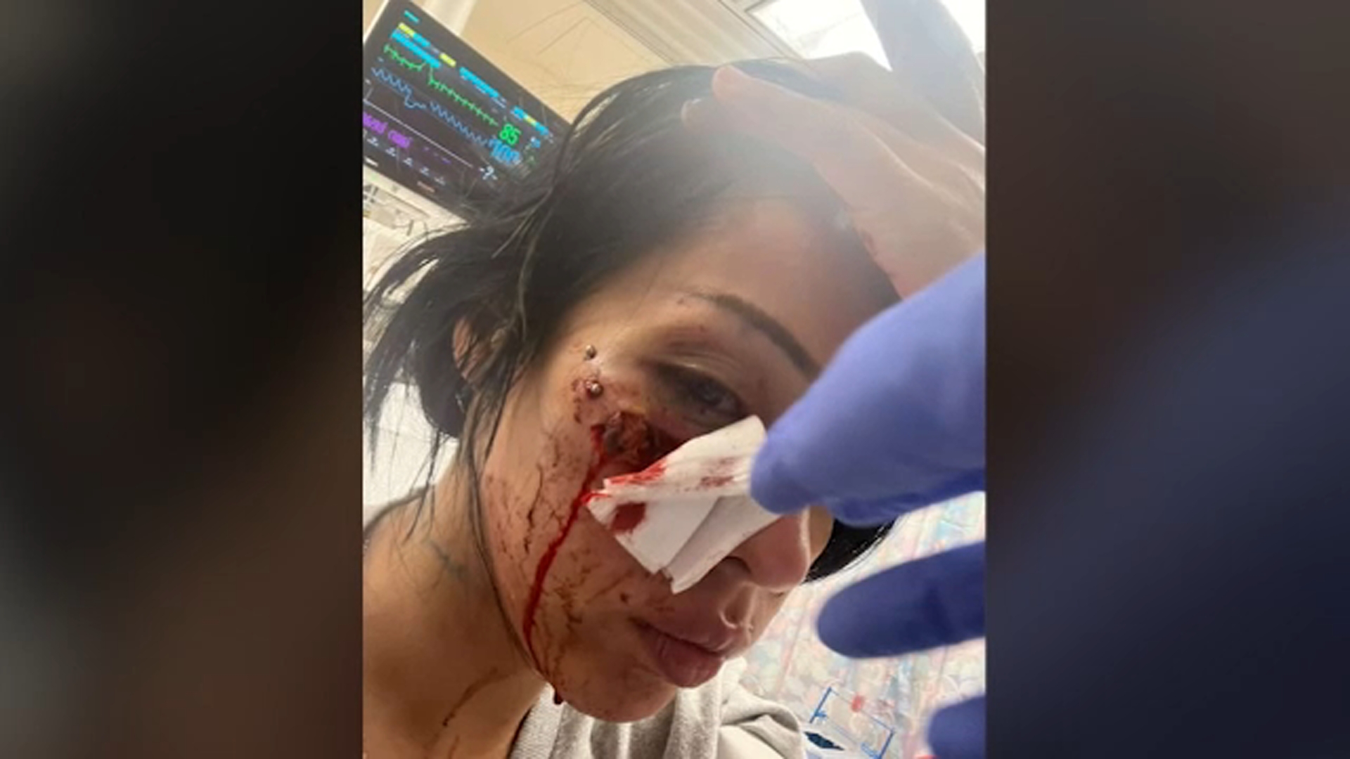 Viewer discretion advised: Images of min Lomas' injury are graphic.