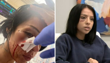 Woman shot in face with less-lethal round during downtown LA ICE protest files claim against Los Angeles police