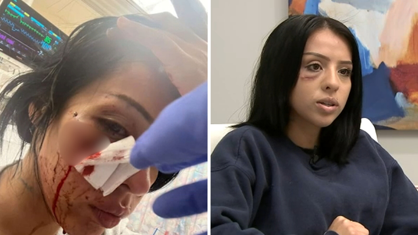 Woman shot in face with less-lethal round during downtown LA ICE protest files claim against Los Angeles police