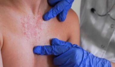 Santa Clara County resident with measles dined at Burlingame restaurant, health authorities say