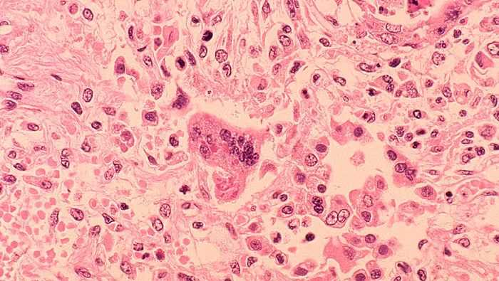 California sees rise in measles cases, health officials say