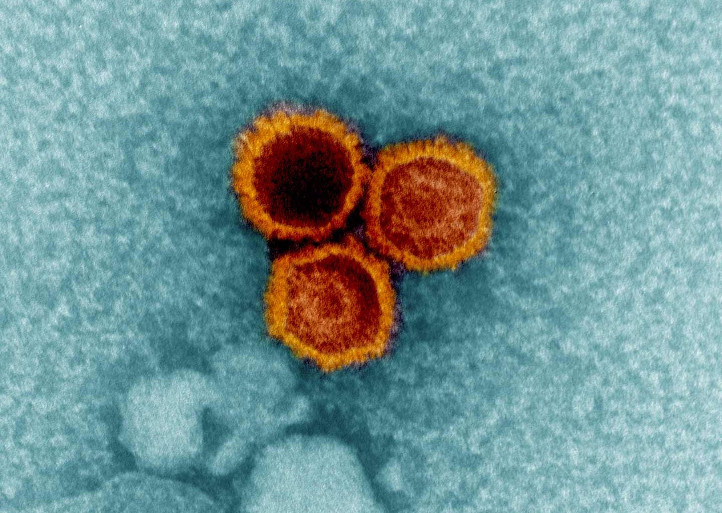 Immune Cells Linked to Epstein-Barr Virus May Play a Role in MS