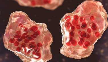 Orange County confirms second measles case in traveler who visited Disneyland, California Adventure