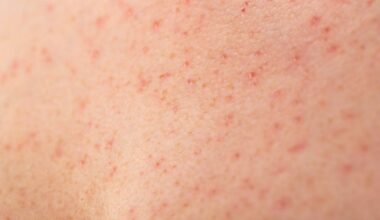 Northern California county reports measles outbreak with 8 cases