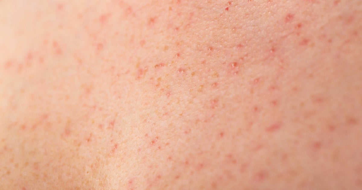 Northern California county reports measles outbreak with 8 cases