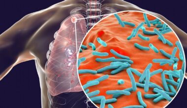 Health Officials Release Assessment Of San Francisco Tuberculosis Outbreak