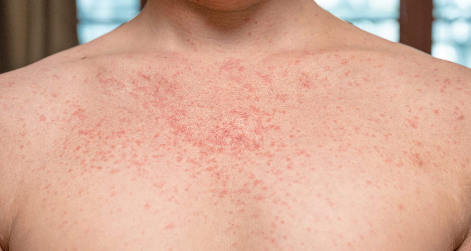 Health Officials Confirm Fourth Measles Case in LACo