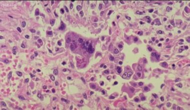 Measles exposure reported at Sharp Memorial Hospital ER