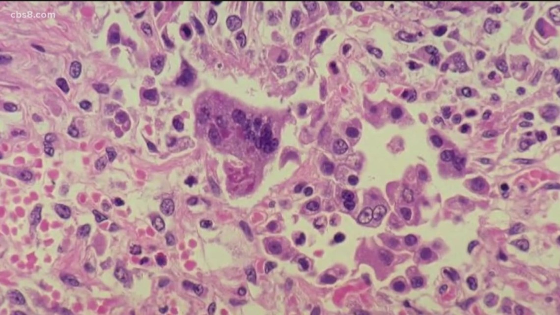 Measles exposure reported at Sharp Memorial Hospital ER