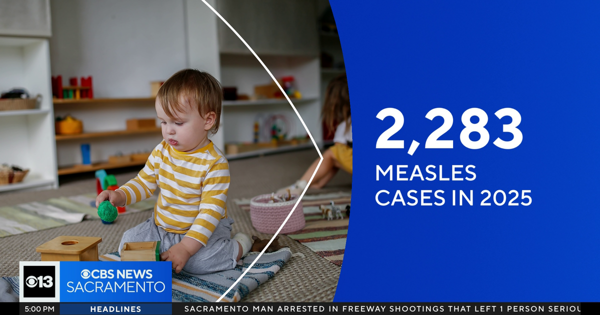 More than 100 Sacramento County children possibly exposed to measles