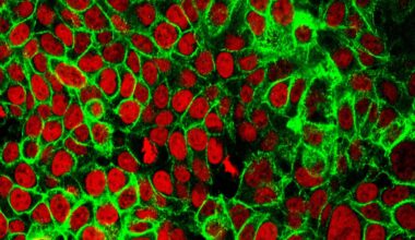 The worrisome increase in colon cancer among young people