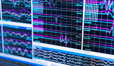 Early schizophrenia signs may hold key to preventing psychosis