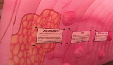 Colon cancer event in Oakland County stresses the importance of early testing