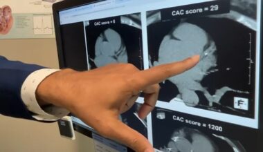 Computerized scan of heart can help prevent potential problems