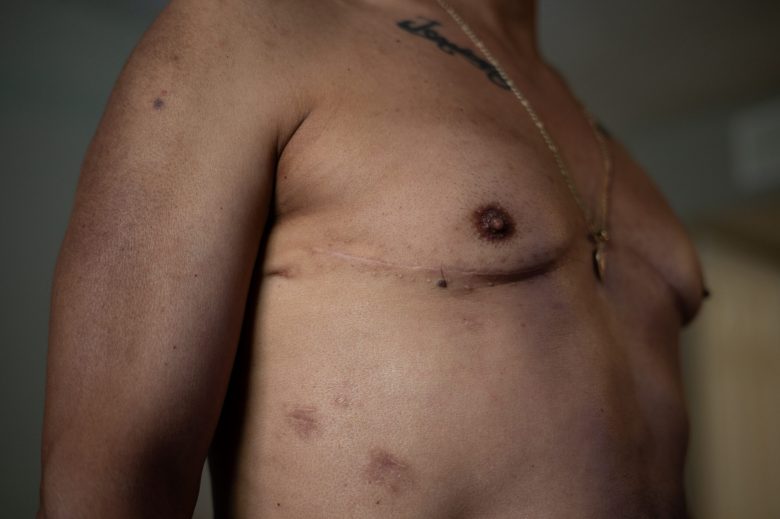A close-up of a shirtless individual showing post-surgery scars on the chest. 
