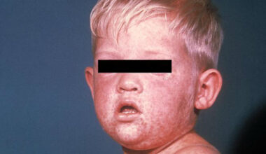 Doctors warn of potentially deadly complications from measles outbreaks