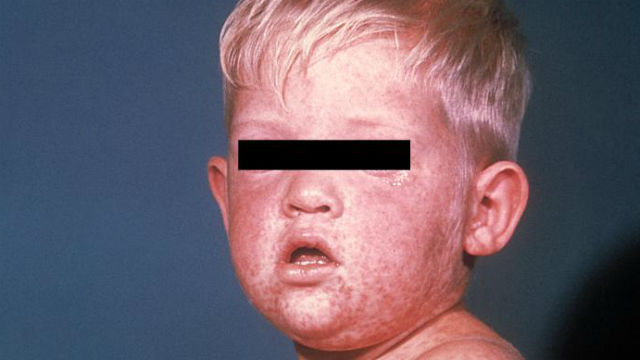 Doctors warn of potentially deadly complications from measles outbreaks
