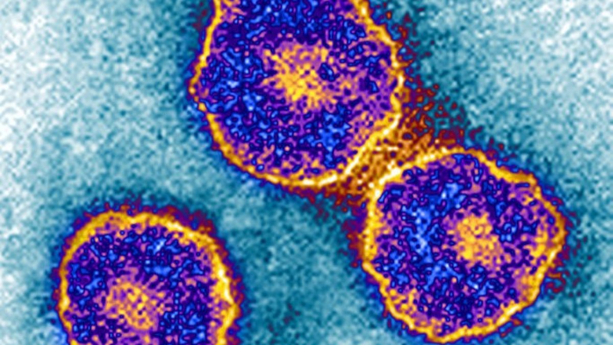 2 cases of mumps detected in Berkeley – NBC Bay Area