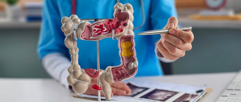 A gastroenterologist’s advice on how to prevent colorectal cancer – San Diego Union-Tribune