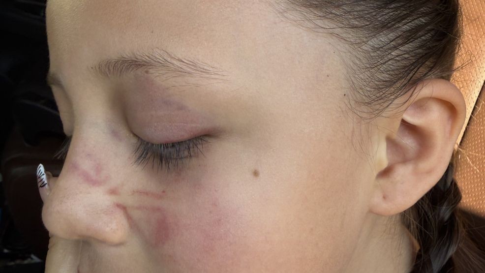 ABBY ORELLANA WAS KICKED IN THE FACE BY ANOTHER CHILD, HER MOTHER SAYS HAS BEEN CONSTANTLY BULLYING HER.{ } PHOTO CREDIT: SANDRA ORELLANA