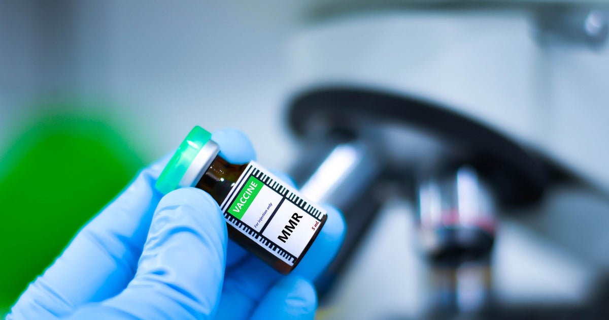 2 unvaccinated Sacramento County children diagnosed with measles, health officials say