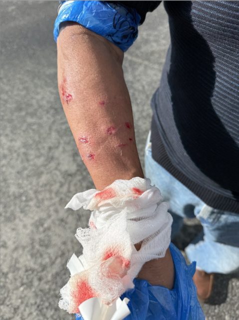 A person with multiple small scrapes and wounds on their forearm, holding a blood-stained bandage over their hand, standing on pavement.
