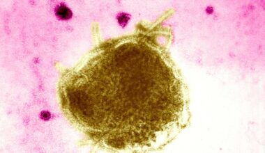 Sacramento County reports measles cases in unvaccinated children