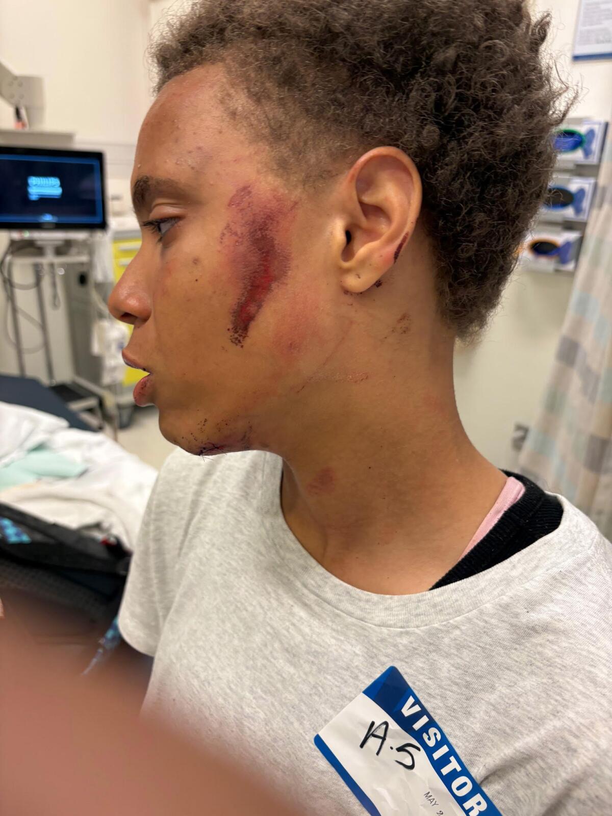 Lawsuit Alleges San Bernardino Officer Hip-Tossed Teen Girl, Face-First, Causing Brain Injury and Memory Loss. 