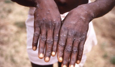 San Francisco reports first case of severe mpox strain
