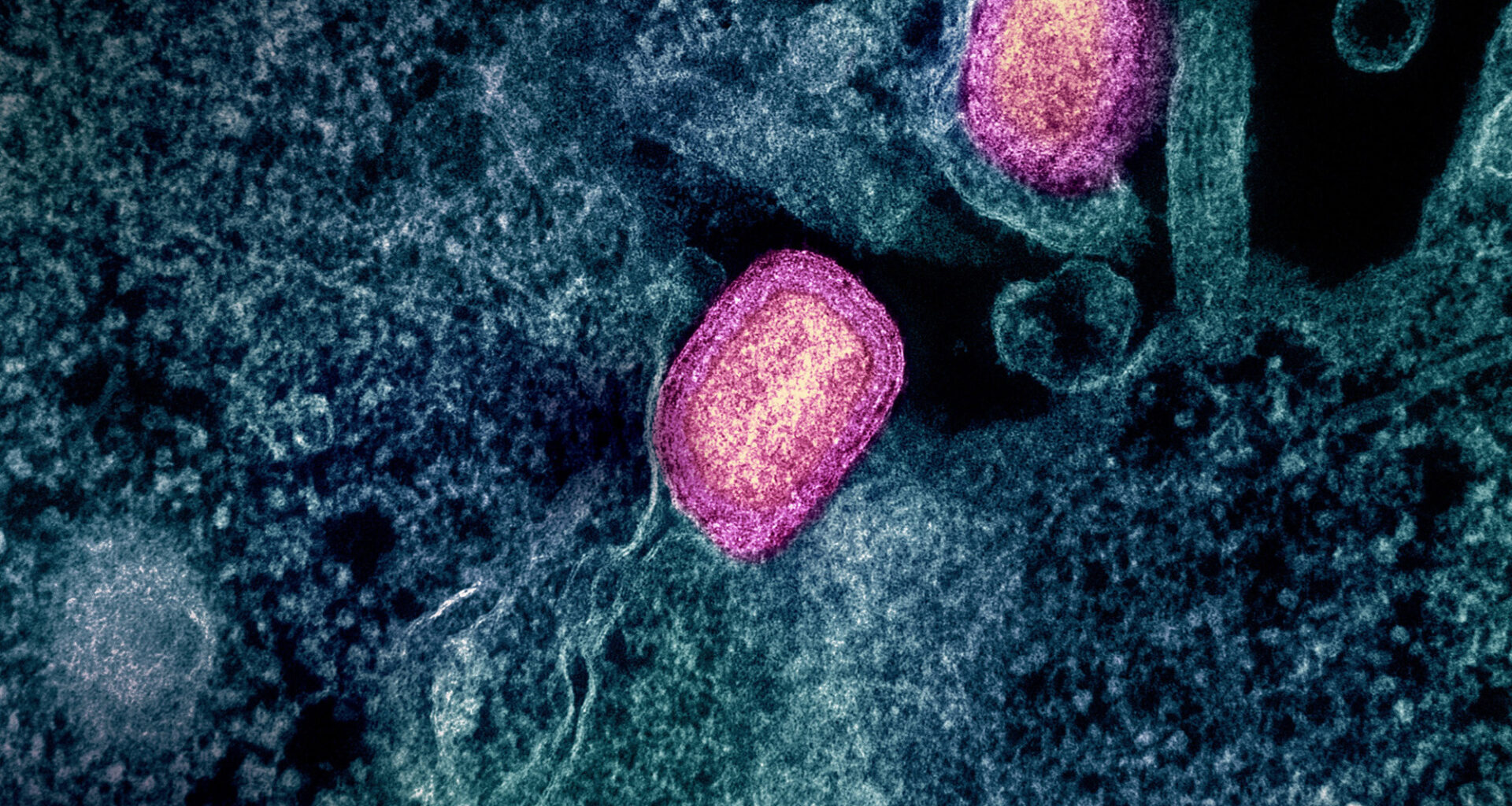 Health Officials Urge Vaccinations After New Case Of Monkeypox Reported