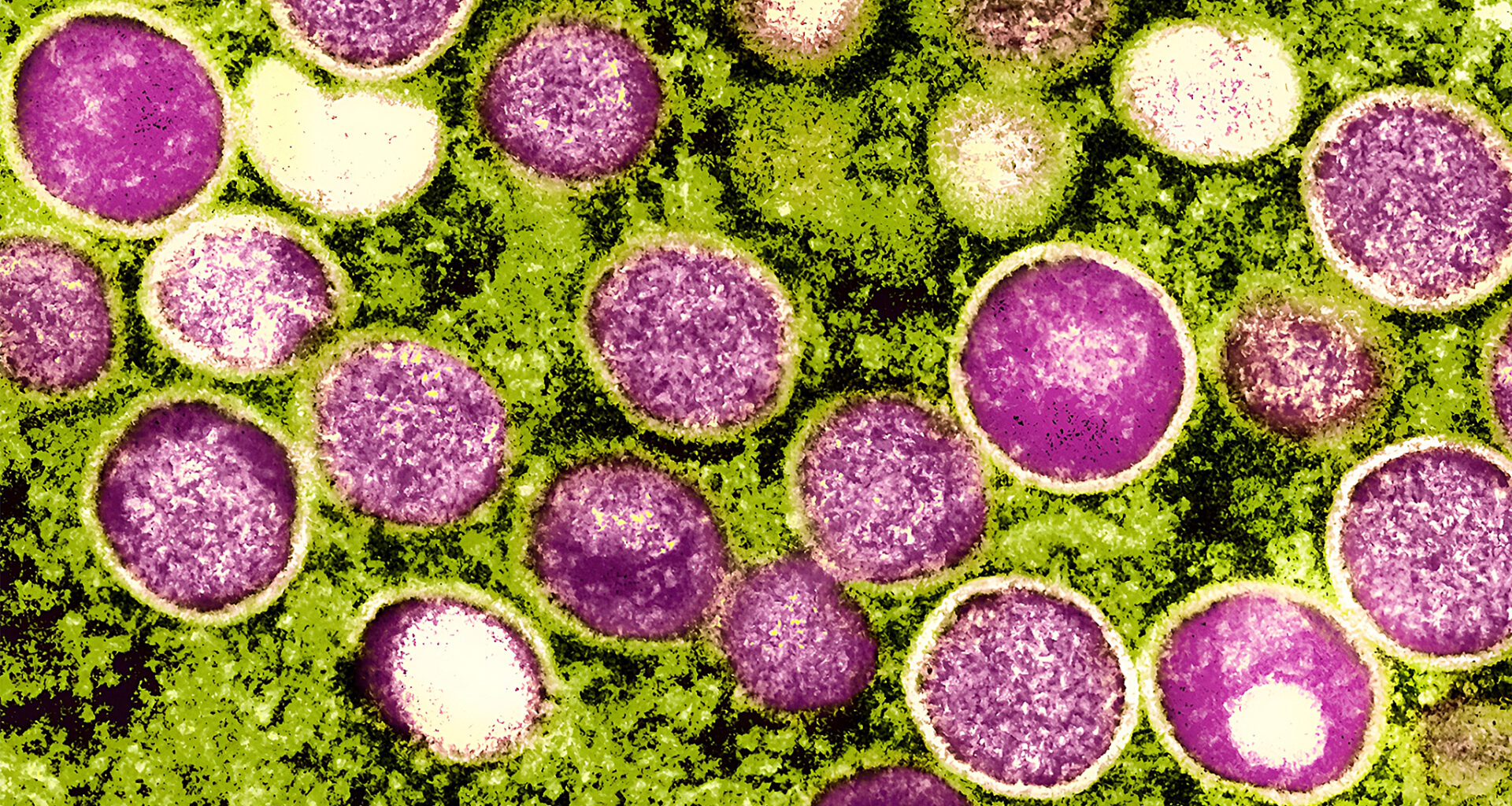 California officials worry as weekly average of rare viral cases rise