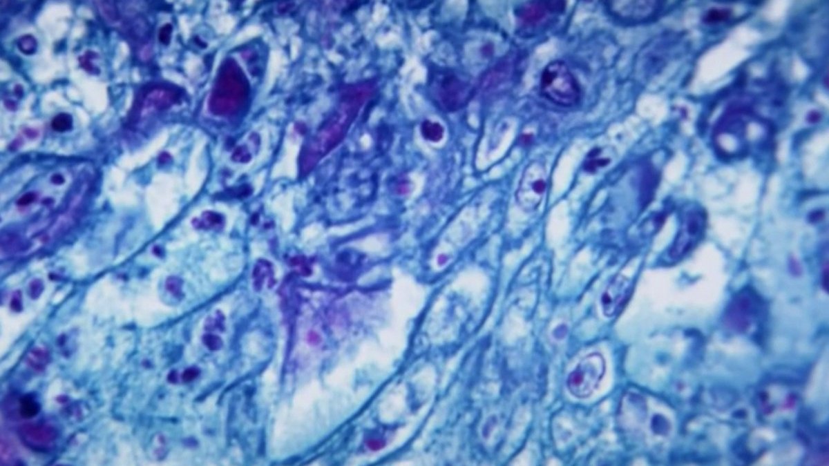 New strain of mpox detected in San Francisco – NBC Bay Area