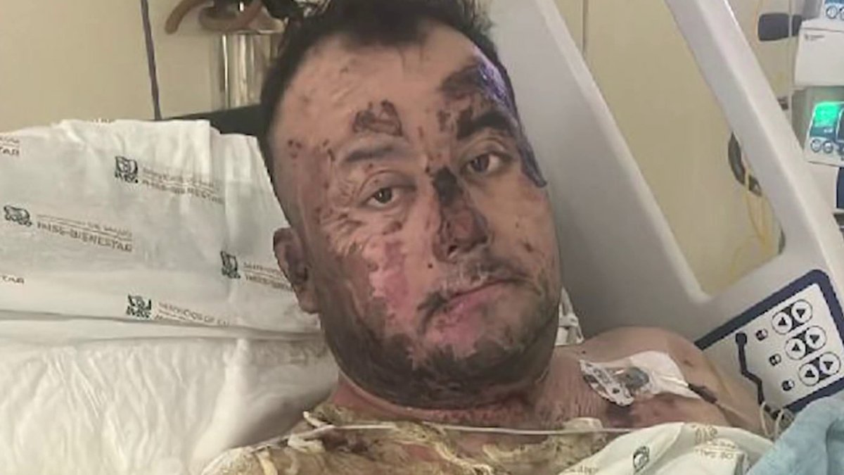 Father severely burned after getting caught in live wires during daughter’s cat rescue in Tijuana – NBC 7 San Diego