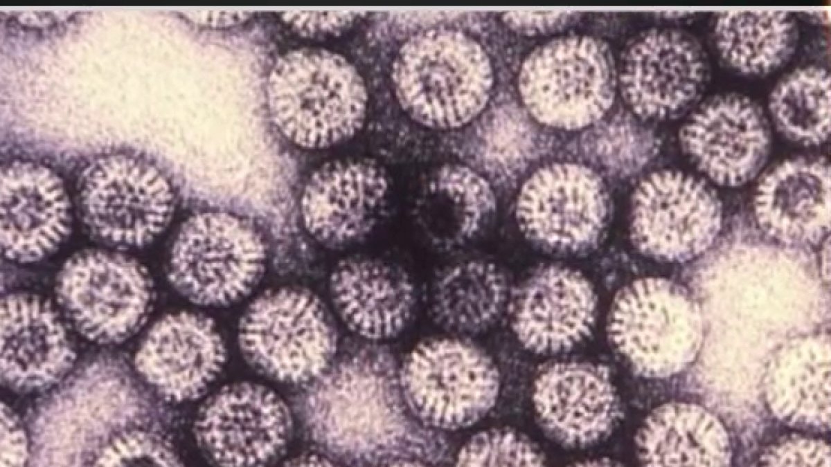 High levels of rotavirus in some Bay Area cities – NBC Bay Area