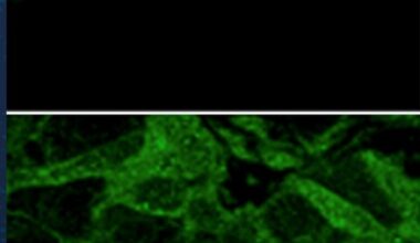 UCSD study focuses on role of type of protein in breast cancer – San Diego Union-Tribune
