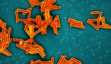 Nearly 1 in 5 affected by TB at SF school