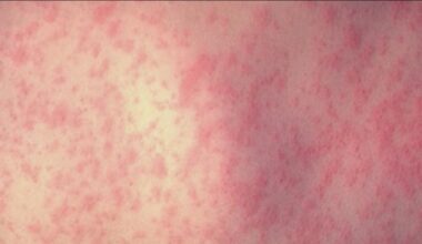 Two measles cases confirmed in San Diego County