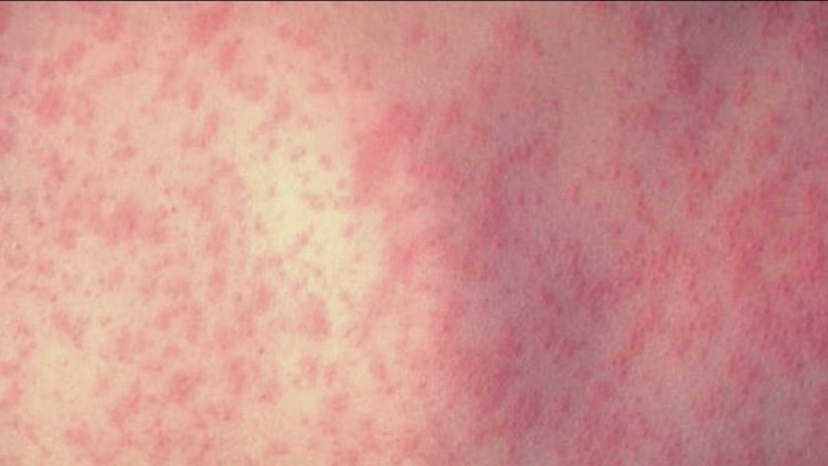 Two measles cases confirmed in San Diego County