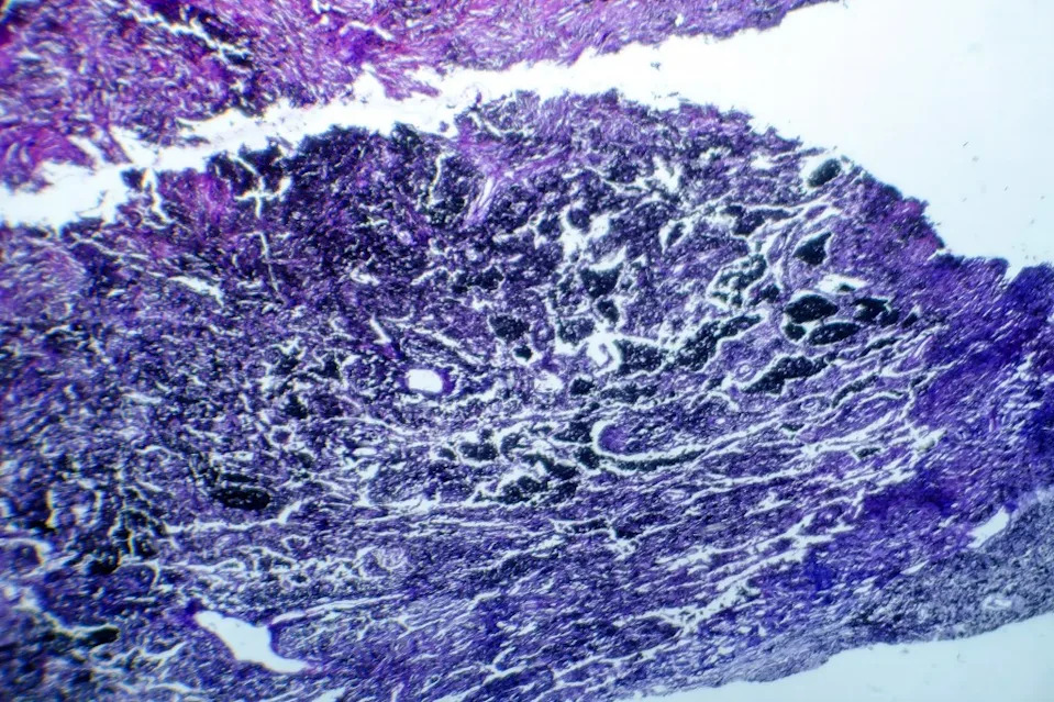 Photomicrograph of lung tissue depicting silicosis pathology under a microscope, revealing silica particle accumulation in alveoli and fibrosis. Dr_Microbe – stock.adobe.com
