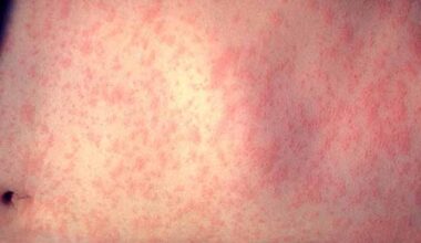 Two measles cases confirmed in San Diego County