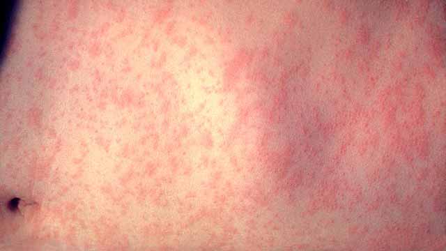 Two measles cases confirmed in San Diego County