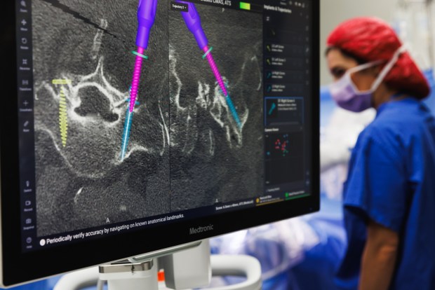 An AI-enabled display depicts the position of surgical screws being inserted into a patient's vertebra during a spinal fusion surgery at Jacobs Medical Center at UC San Diego Health in La Jolla on Wednesday, April 29, 2026. (Kristian Carreon / The San Diego Union-Tribune)