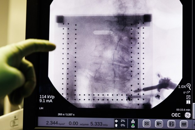 An X-ray is taken of a patient's spine before a spinal fusion surgery at Jacobs Medical Center at UC San Diego Health in La Jolla on Wednesday, April 29, 2026. (Kristian Carreon / The San Diego Union-Tribune)