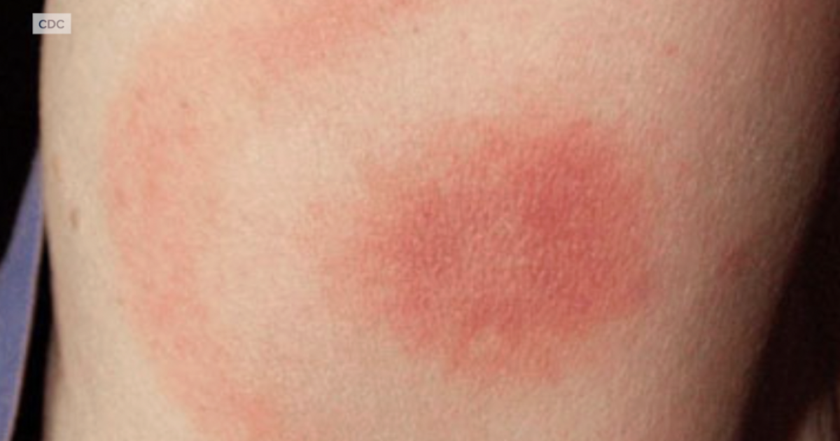 Kern County health officials warn of bad tick season