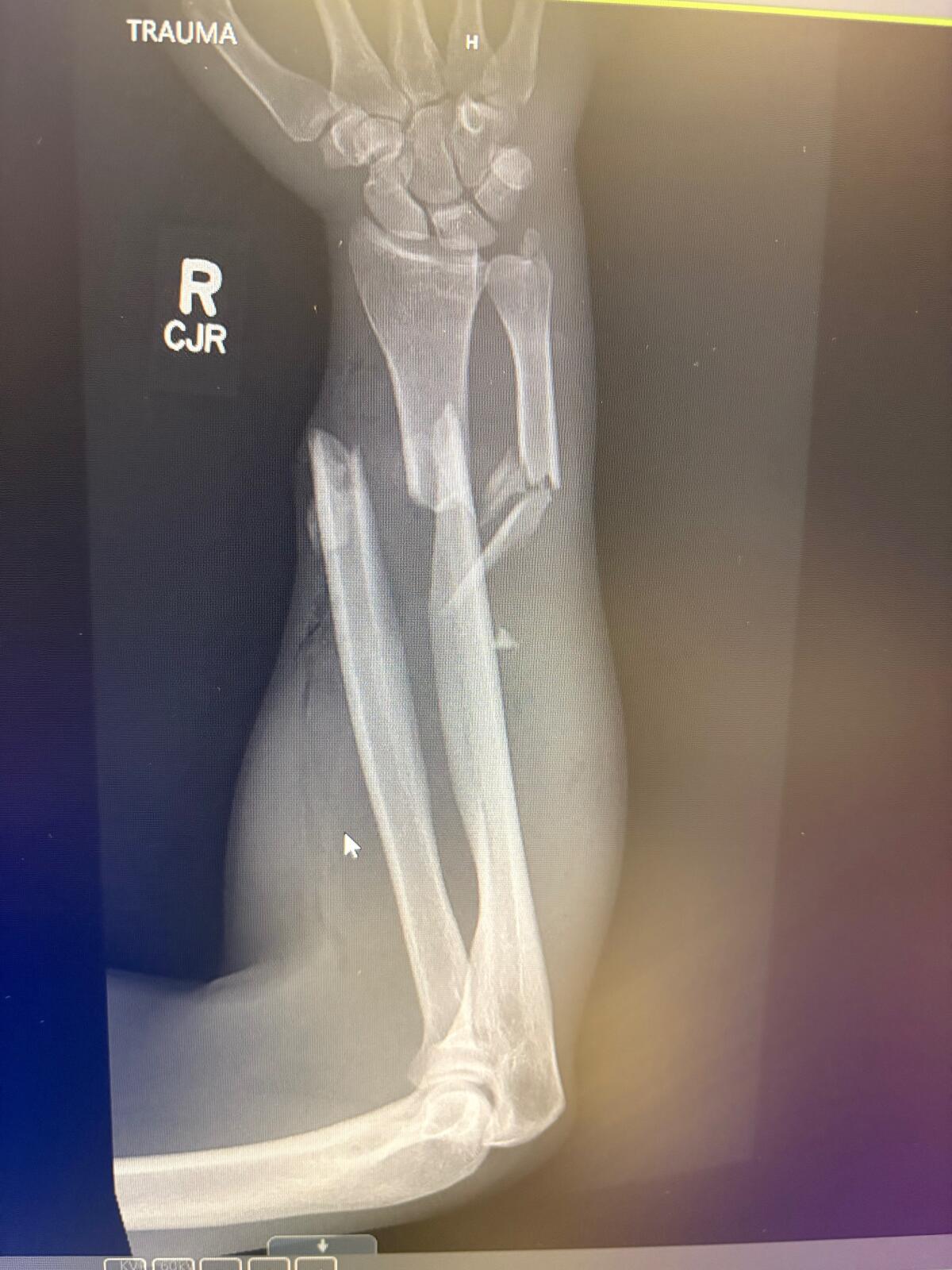 Daniel Crago took a vacation to Glacier National Park where he was attacked by a grizzly bear, breaking his arm.