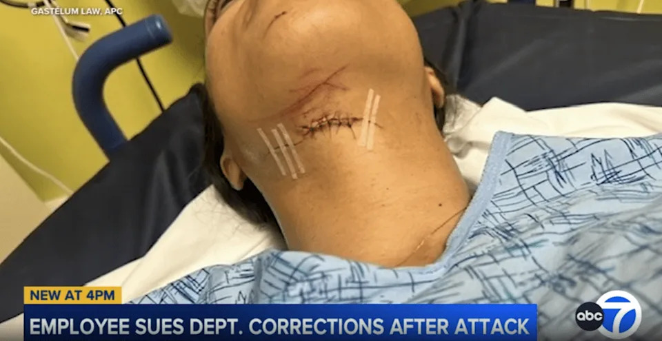 A woman with a stitched laceration and scratches on her neck, lying in a hospital bed.