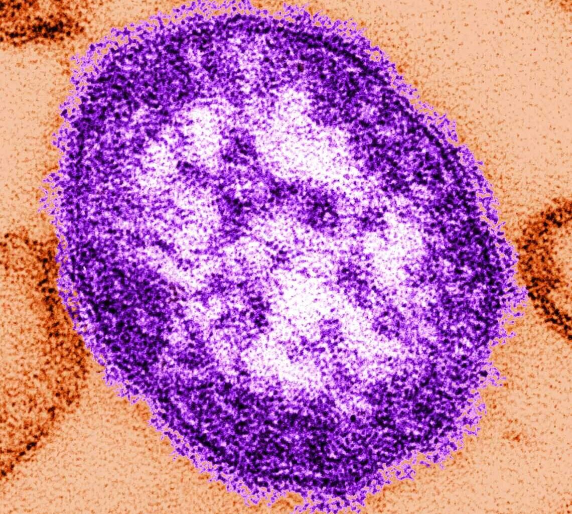 Measles outbreak in Sacramento, Placer counties declared over after 42 days