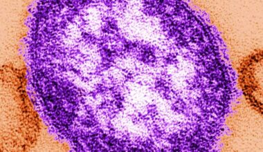 Measles outbreak in Sacramento, Placer counties declared over after 42 days