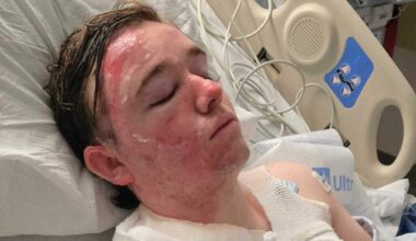 Yuba City fast food worker in hot oil attack thanks supporters