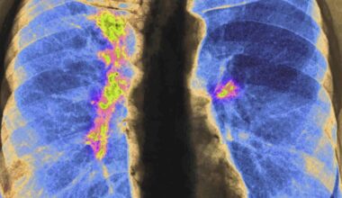 Some Asian American communities experiencing high rates of certain cancers